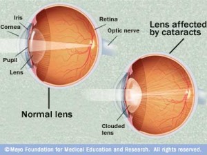 cataract1_big[1]